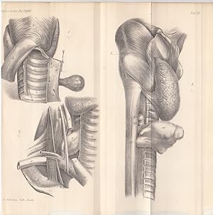 Retentionszysten. Lithographie von A. Schütze aus Virchows Arch. path. Anat., 74, 22 x 22 cm, 1878.