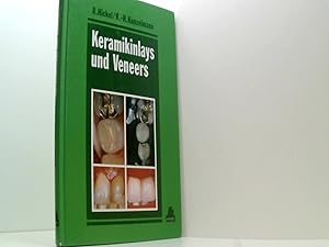 Keramikinlays und Veneers