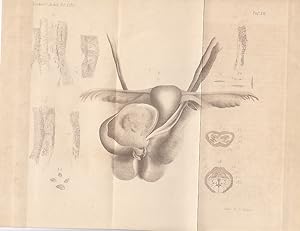 Einseitige Hydronephrose (Uretrovesicalfistel). Lithographie von W. A. Meyn, 21,5 x 27,5 cm, aus ...