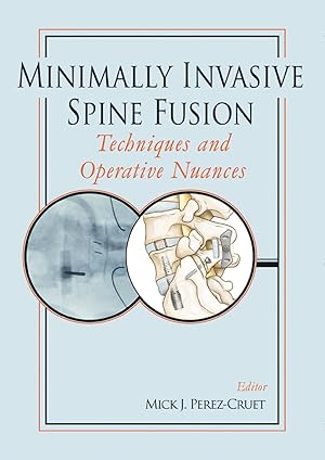 Bild des Verkufers fr Minimally Invasive Spine Fusion: Techniques and Operative Nuances zum Verkauf von moluna