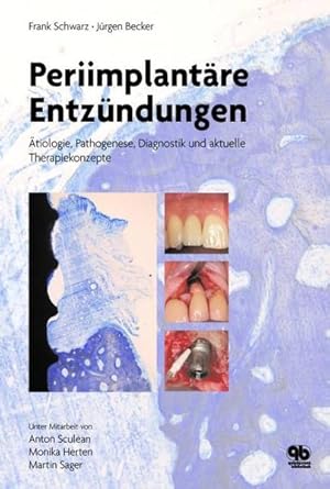 Periimplantäre Entzündungen: Ätiologie, Pathogenese, Diagnostik und aktuelle Therapiekonzepte