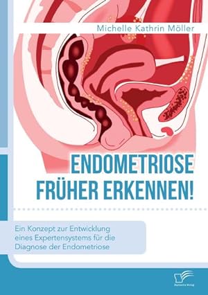 Seller image for Endometriose frher erkennen! Ein Konzept zur Entwicklung eines Expertensystems fr die Diagnose der Endometriose for sale by Rheinberg-Buch Andreas Meier eK