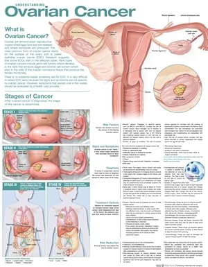 Imagen del vendedor de Understanding Ovarian Cancer Anatomical Chart a la venta por GreatBookPrices