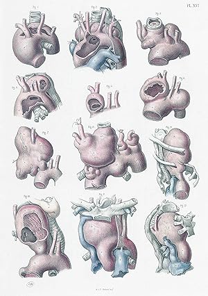 Imagen del vendedor de 1856 Antique Lithograph SURGICAL ANATOMY Aortic Aneurysms Maclise (SA17) a la venta por Antique Paper Company