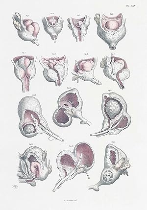 Imagen del vendedor de 1856 Lithograph SURGICAL ANATOMY Prostate Diseases Deformities Maclise (SA-10) a la venta por Antique Paper Company