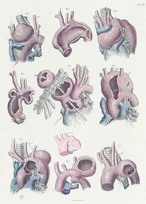 Imagen del vendedor de 1856 Lithograph SURGICAL ANATOMY Aortic Aneurysms Maclise (SA41) a la venta por Antique Paper Company