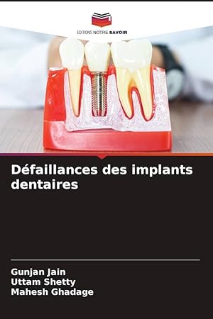 Seller image for Dfaillances des implants dentaires for sale by moluna