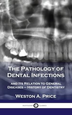 Image du vendeur pour Pathology of Dental Infections: and Its Relation to General Diseases - History of Dentistry by Price, Weston a [Hardcover ] mis en vente par booksXpress
