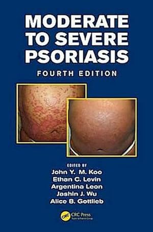 Bild des Verkufers fr Moderate to Severe Psoriasis zum Verkauf von CSG Onlinebuch GMBH