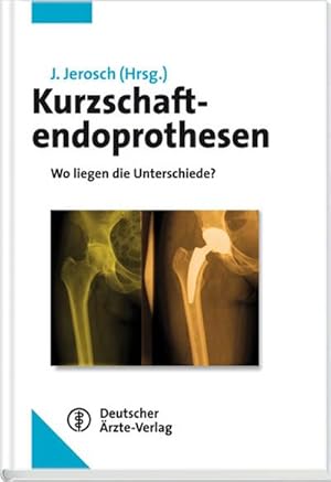 Imagen del vendedor de Kurzschaftendoprothesen: Wo liegen die Unterschiede? a la venta por CSG Onlinebuch GMBH