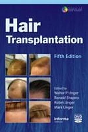 Bild des Verkufers fr Hair Transplantation (Series in Cosmetic and Laser Therapy) zum Verkauf von CSG Onlinebuch GMBH
