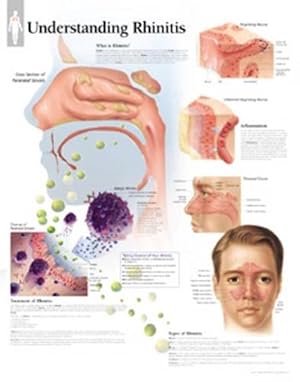 Imagen del vendedor de Understanding Rhinitis Paper Poster (Paperback) a la venta por Grand Eagle Retail