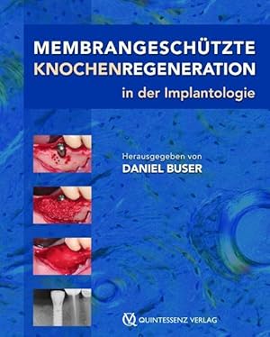 Membrangeschützte Knochenregeneration in der Implantologie