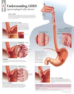 Seller image for Understanding GERD (Gastroesophageal Reflux Disease) Paper Poster (Paperback) for sale by Grand Eagle Retail