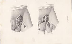 Bruchschnitt - Herniotomia. 2 x Stahlstich von Greb, 1860, 23,7 cm x 15,7 cm.