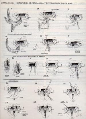 Seller image for LAMINA V20237: Extirpacion de fistula anal y extirpacion de fisura anal for sale by EL BOLETIN