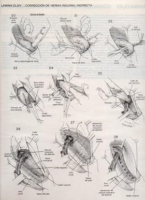Seller image for LAMINA V20225: Correccion de hernia inguinal indirecta 2 for sale by EL BOLETIN