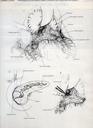 Seller image for LAMINA V20144: Pancreaticoyeyunostomia, tecnica de Puestow-Gillesby for sale by EL BOLETIN