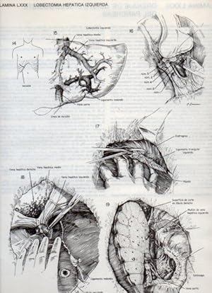 Seller image for LAMINA V20141: Lobectomia hepatica izquierda for sale by EL BOLETIN