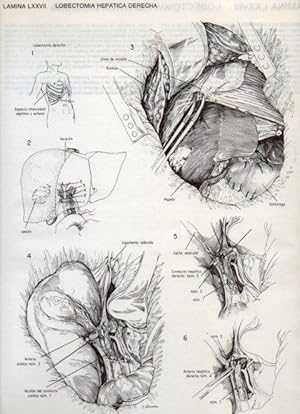 Seller image for LAMINA V20138: Lobectomia hepatica derecha for sale by EL BOLETIN