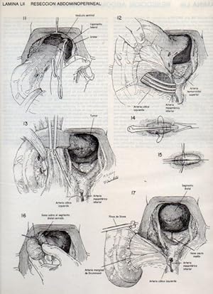 Seller image for LAMINA V20113: Reseccion abdominoperineal 2 for sale by EL BOLETIN