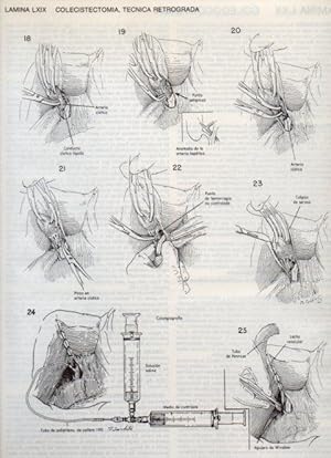 Seller image for LAMINA V20130: Colecistectomia 2, tecnica retrograda for sale by EL BOLETIN