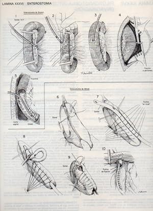 Seller image for LAMINA V20097: Enterostomia for sale by EL BOLETIN