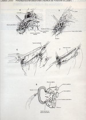 Seller image for LAMINA V20145: Pancreaticoyeyunostomia, tecnica de Puestow-Gillesby 1 for sale by EL BOLETIN