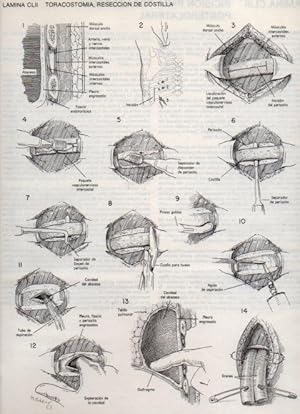 Seller image for LAMINA V20213: Toracostomia, reseccion de costilla for sale by EL BOLETIN