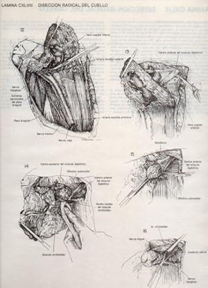 Seller image for LAMINA V20209: Diseccion radical del cuello 2 for sale by EL BOLETIN