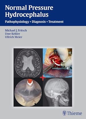 Bild des Verkufers fr Normal Pressure Hydrocephalus : Pathophysiology, Diagnosis, Treatment zum Verkauf von GreatBookPrices