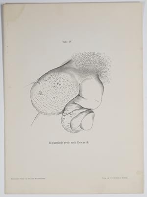 Die elephantiastischen Formen: Tafel 4: Elephantiasis penis nach Esmarch.