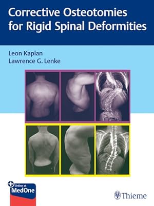 Immagine del venditore per Corrective Osteotomies For Rigid Spinal Deformities venduto da GreatBookPricesUK