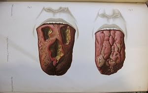 Des glossites tertiaires (Glossites scléreuses ; glossites gommeuses)