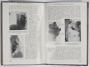 Bild des Verkufers fr Exstirpation eines ganzen Lungenflgels. zum Verkauf von Antiq. F.-D. Shn - Medicusbooks.Com