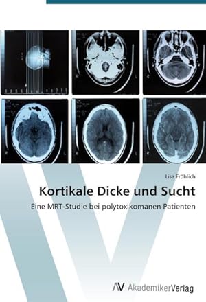 Bild des Verkufers fr Kortikale Dicke und Sucht zum Verkauf von BuchWeltWeit Ludwig Meier e.K.