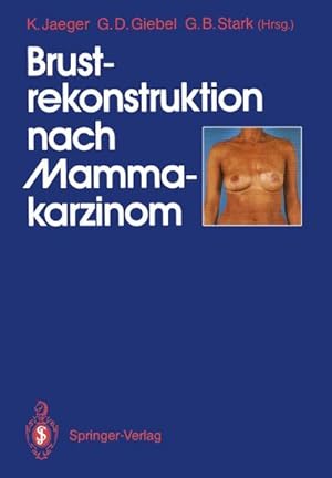 Seller image for Brustrekonstruktion nach Mammakarzinom for sale by BuchWeltWeit Ludwig Meier e.K.