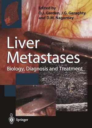 Seller image for Liver Metastases for sale by BuchWeltWeit Ludwig Meier e.K.