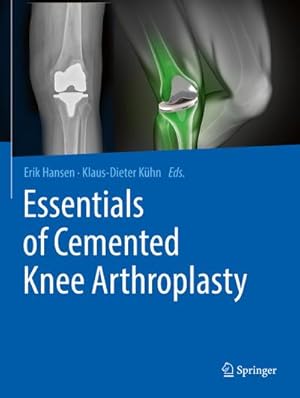 Seller image for Essentials of Cemented Knee Arthroplasty for sale by BuchWeltWeit Ludwig Meier e.K.