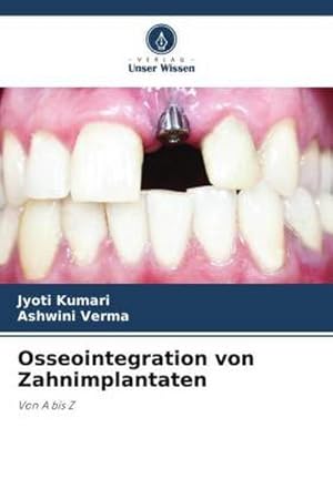 Seller image for Osseointegration von Zahnimplantaten for sale by BuchWeltWeit Ludwig Meier e.K.