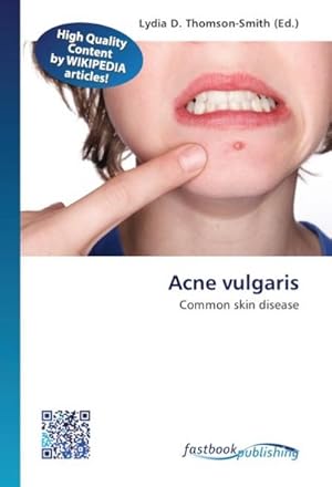 Seller image for Acne vulgaris for sale by BuchWeltWeit Ludwig Meier e.K.