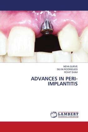Seller image for ADVANCES IN PERI-IMPLANTITIS for sale by moluna