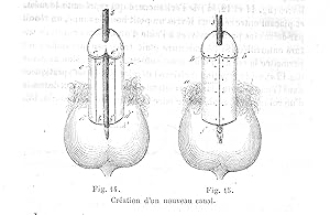 De l'hypospadias périnéo-scrotal et de son traitement chirurgical, In : Archives Générales de Méd...