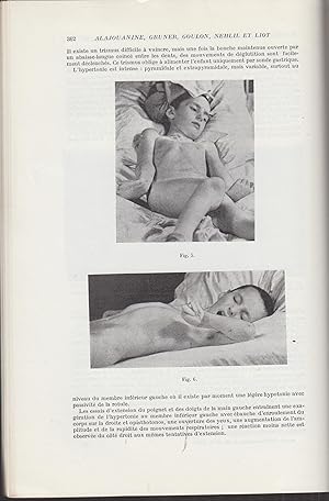 Bild des Verkufers fr Revue Neurologique - Organe Officiel des Socit Franaise de Neurologie, Socit d'lectroencphalographie de Langue Franaise. - Tome 95 - N 5 - Novembre 1956 (2e Semestre). zum Verkauf von PRISCA