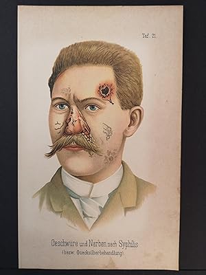 Chromolithografie von 1890. Geschwüre und Narben nach Syphilis.