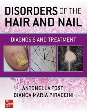 Bild des Verkufers fr Disorders of the Hair and Nail: Diagnosis and Treatment zum Verkauf von AHA-BUCH GmbH