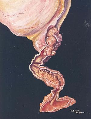 Seller image for Clinical cystoscopy : a treatise on cystoscopic technic, diagnosis, procedures and treatment. [History of the Cystoscope; The cystoscope; Preparation of the patient; Introduction of the cystosco pe; The normal bladder; Cystitis; Miscellaneous affectations of Bladder; Miscellaneous addections of bladder; Tumors of the bladder; Tumors of the bladder; Vesical Calculus; The neurogenic bladder; Prostatic hypertrophy; The uret ers; Ureteral catheterization; Vol. 2; Renal anomalies; Renal function tests; Injuries to the kidney; Hydronephrosis; Nontuberculous infections of the kidney; Medical diseases of the kidney; Specific infections of the kidney; Specific infections of the kidney; Specific infections of the kidney; Renal cysts; Renal calculus] for sale by Joseph Valles - Books