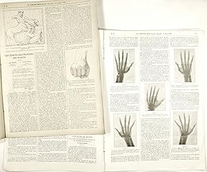 (Lot de 2 fascicles). LENOIR (Olivier). La fracture des boxeurs. Fracture de l'extrémité inférieu...