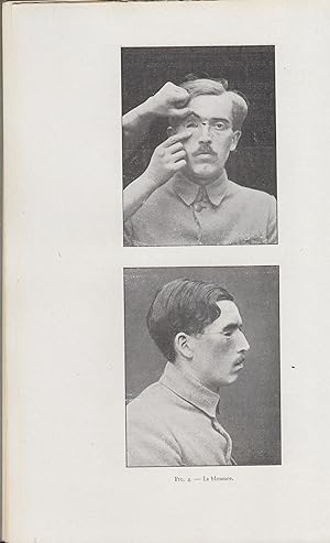 Seller image for La Restauration Maxillo-Faciale - Revue pratique de chirurgie et prothse spciales - Deuxime anne - N 3 - Mars 1918. for sale by LIBRAIRIE PIMLICO