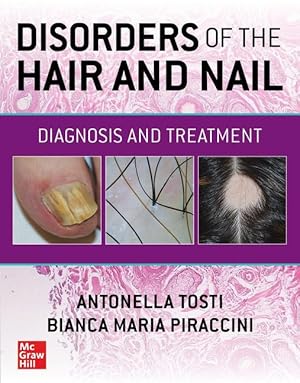 Bild des Verkufers fr Disorders of the Hair and Nail: Diagnosis and Treatment zum Verkauf von moluna